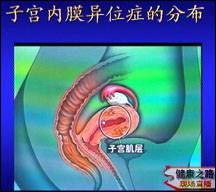 盆腔外子宫内膜异位症