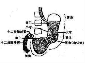 胃轻瘫综合症