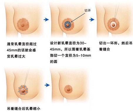 乳晕缩小术