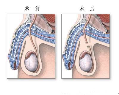 输精管结扎术