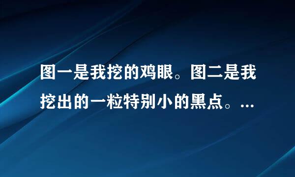 图一是我挖的鸡眼。图二是我挖出的一粒特别小的黑点。不知道是不是根。淘宝客服叫我继续贴。因为我的洞还