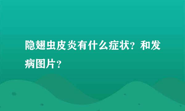 隐翅虫皮炎有什么症状？和发病图片？