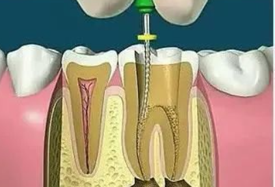 根管预备是来自什么？