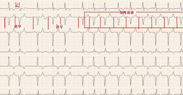 体检报来自告上写着 房性心律是什么意思缺石皇务世频刑什治啊？