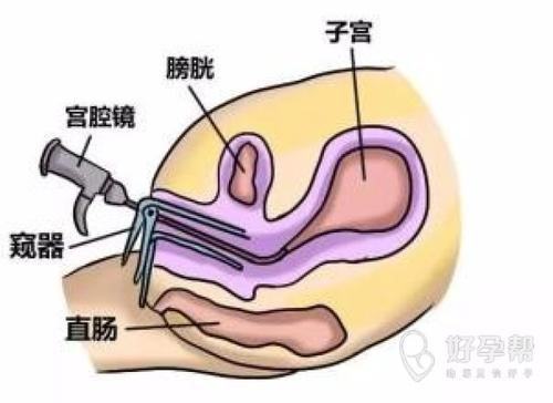 上海宫腔镜手术大概多少费用