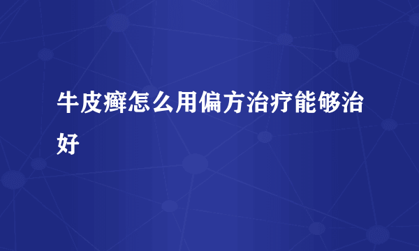 牛皮癣怎么用偏方治疗能够治好